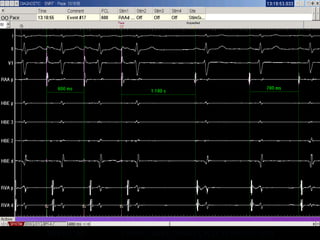 61
SNRT:1180 CSNRT: SNRT- SINUS CYCLE LENGTH = 400
 