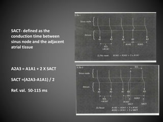 SACT- defined as the
conduction time between
sinus node and the adjacent
atrial tissue
A2A3 = A1A1 + 2 X SACT
SACT =(A2A3-A1A1) / 2
Ref. val. 50-115 ms
 