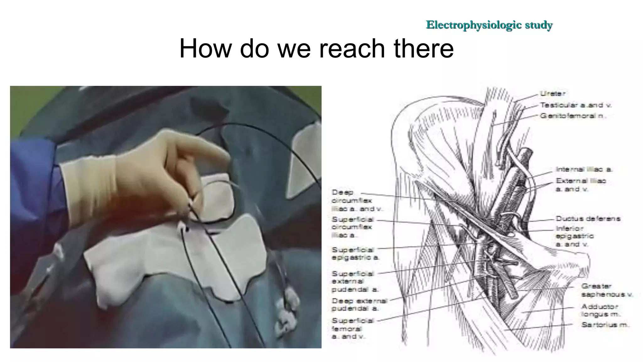 Basics of Electrophysiologic study, part 1 (2020)