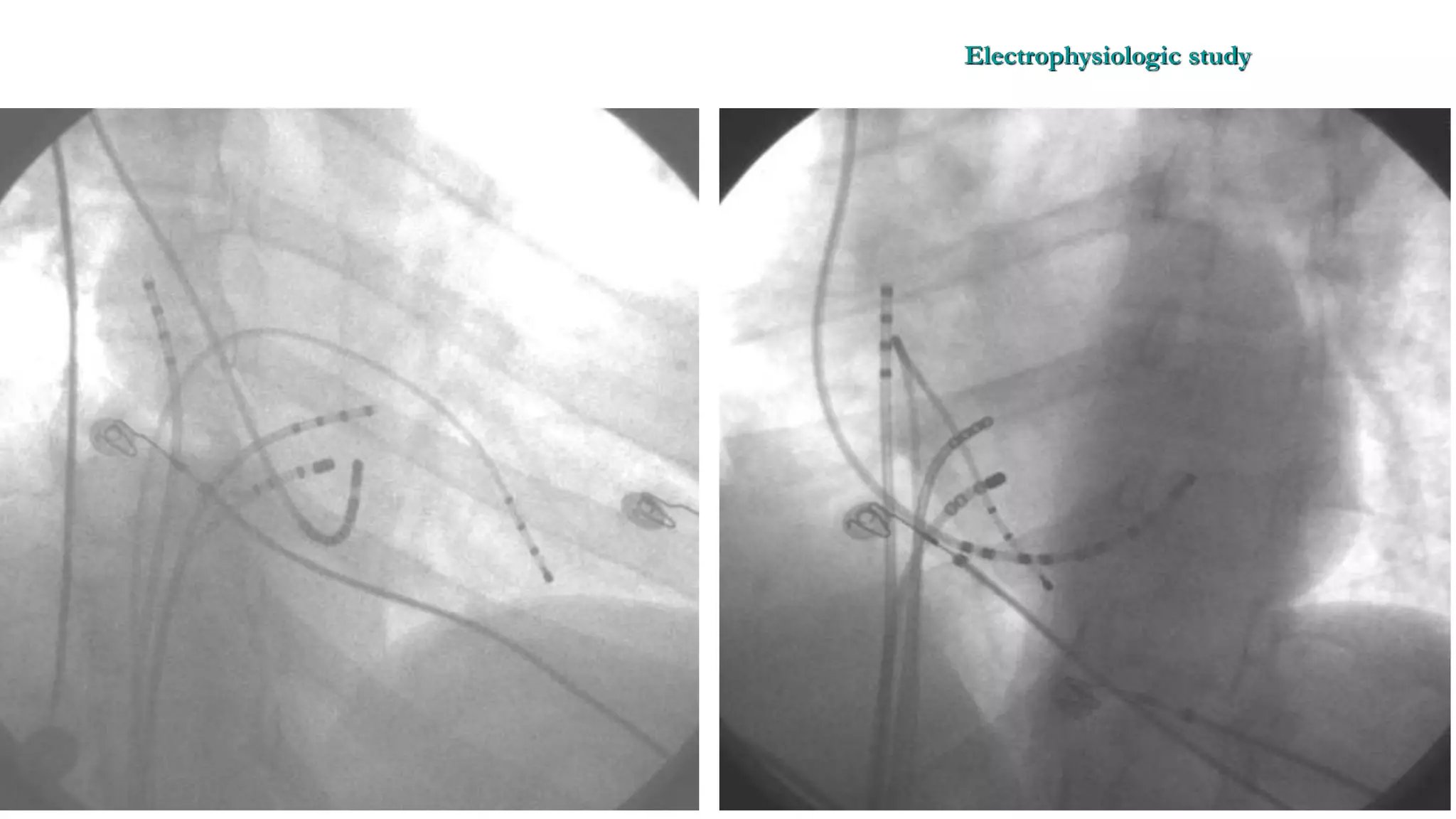 Basics of Electrophysiologic study, part 1 (2020)