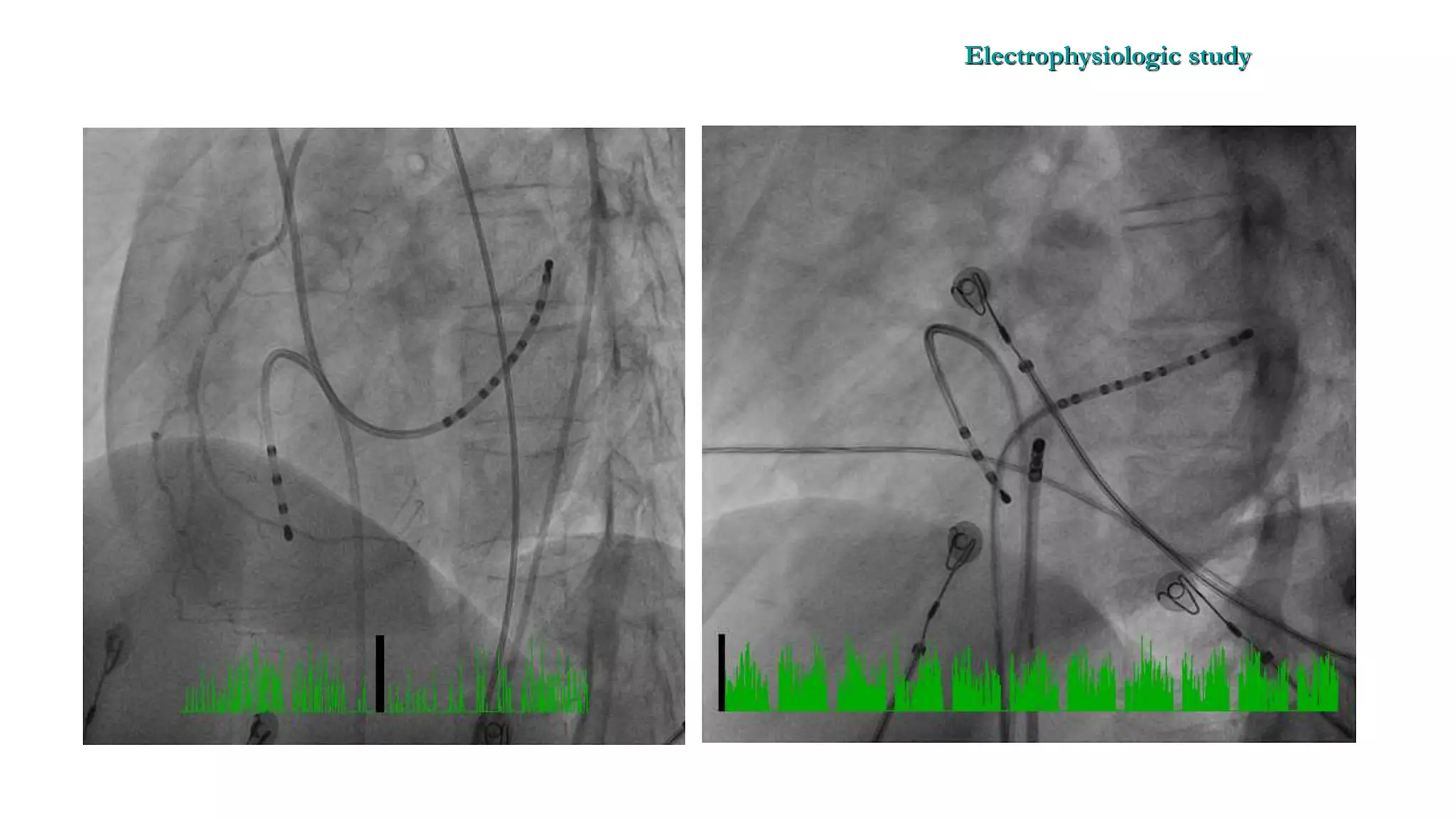 Basics of Electrophysiologic study, part 1 (2020)