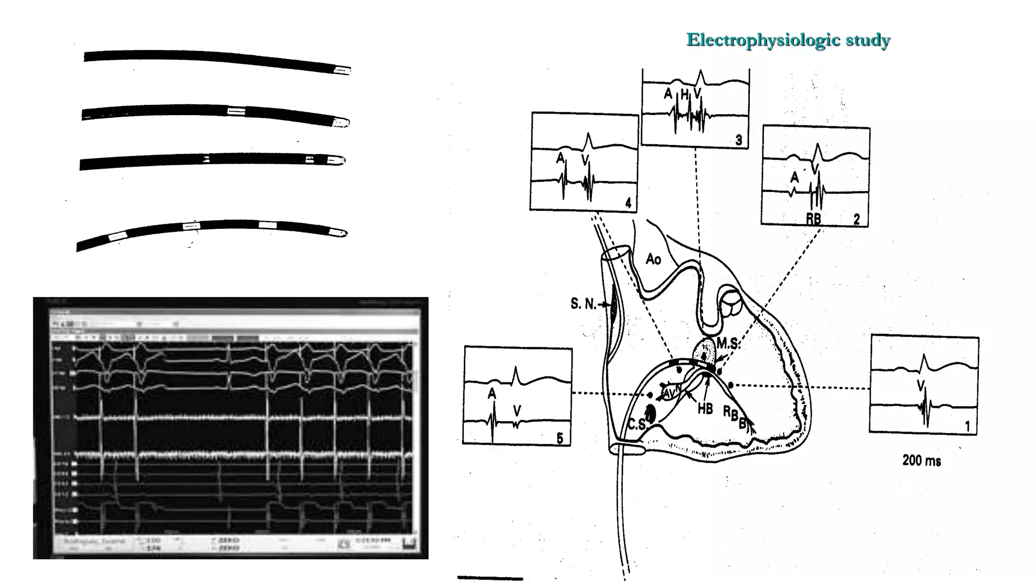 Basics of Electrophysiologic study, part 1 (2020)