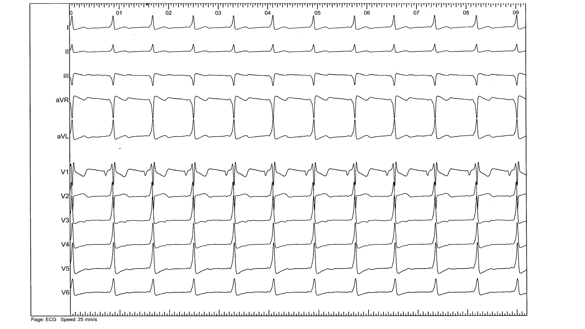 Basics of Electrophysiologic study, part 1 (2020)