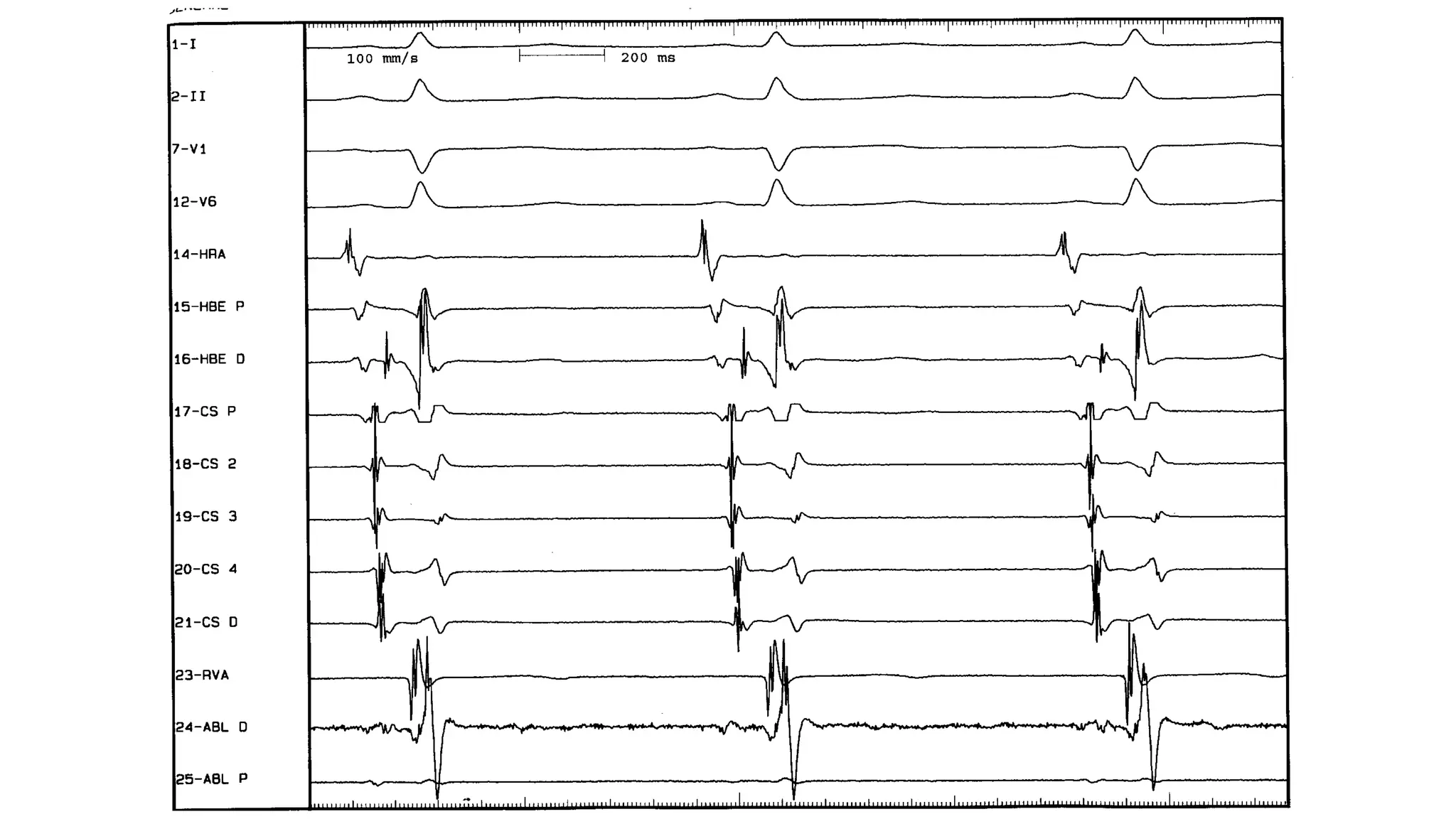 Basics of Electrophysiologic study, part 1 (2020)