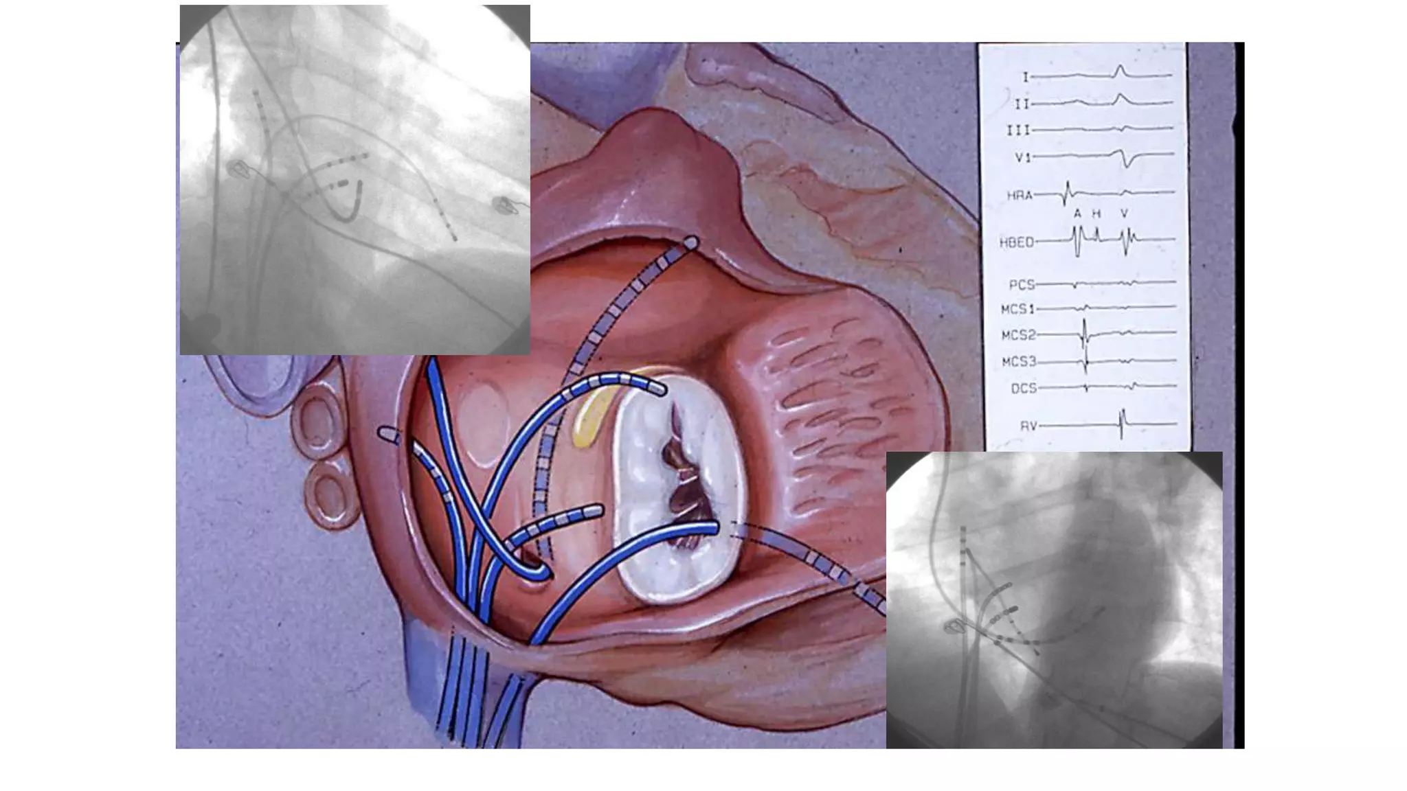Basics of Electrophysiologic study, part 1 (2020)