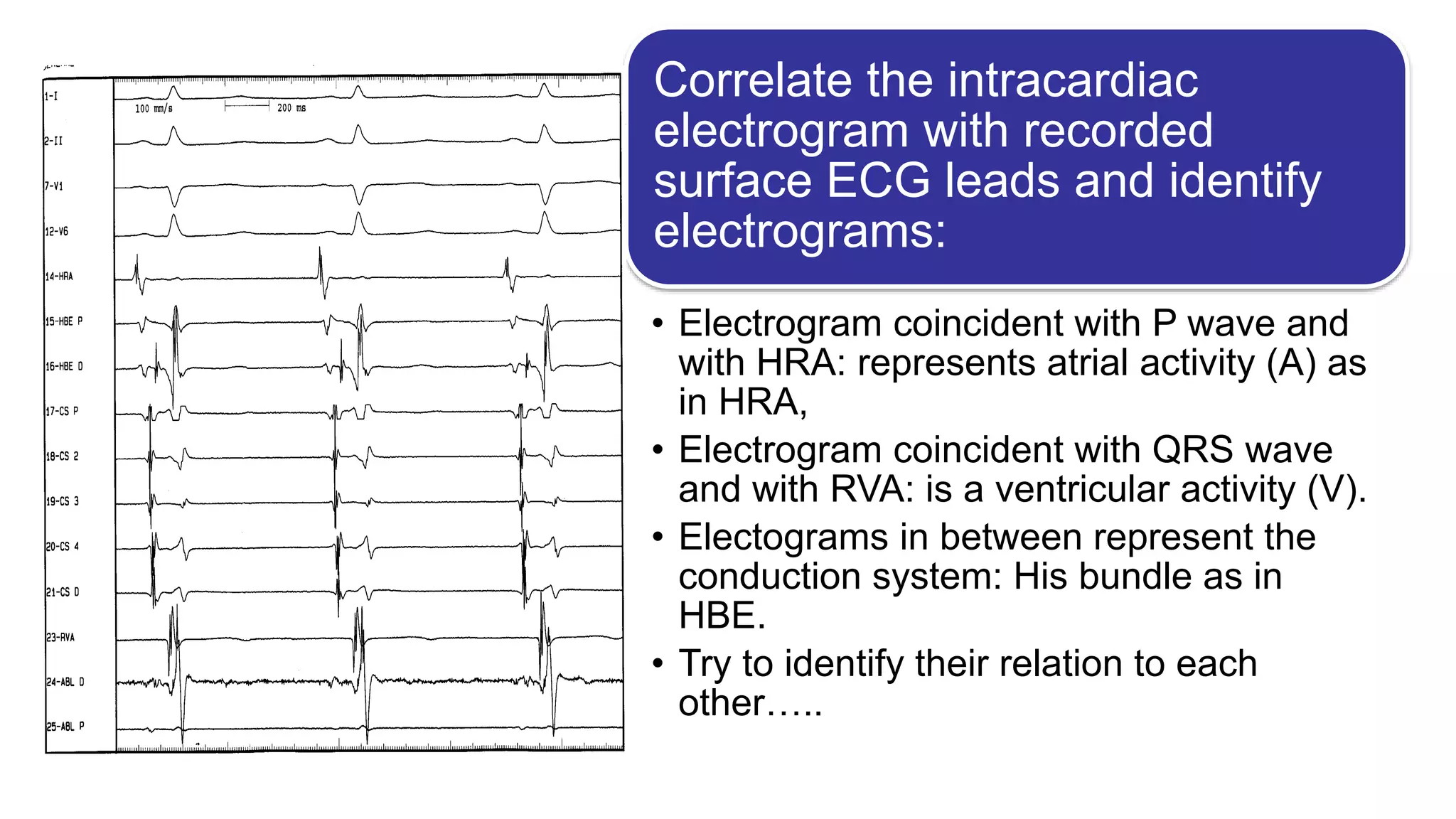Basics of Electrophysiologic study, part 1 (2020)