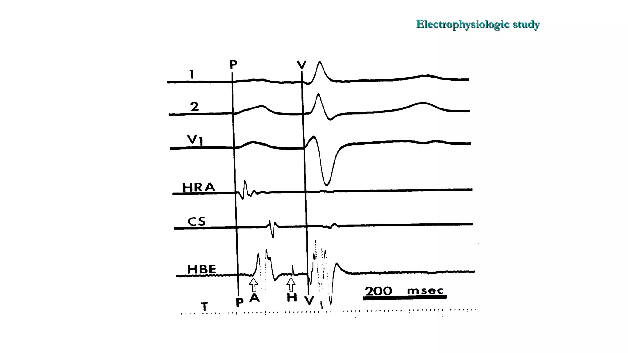Basics of Electrophysiologic study, part 1 (2020)
