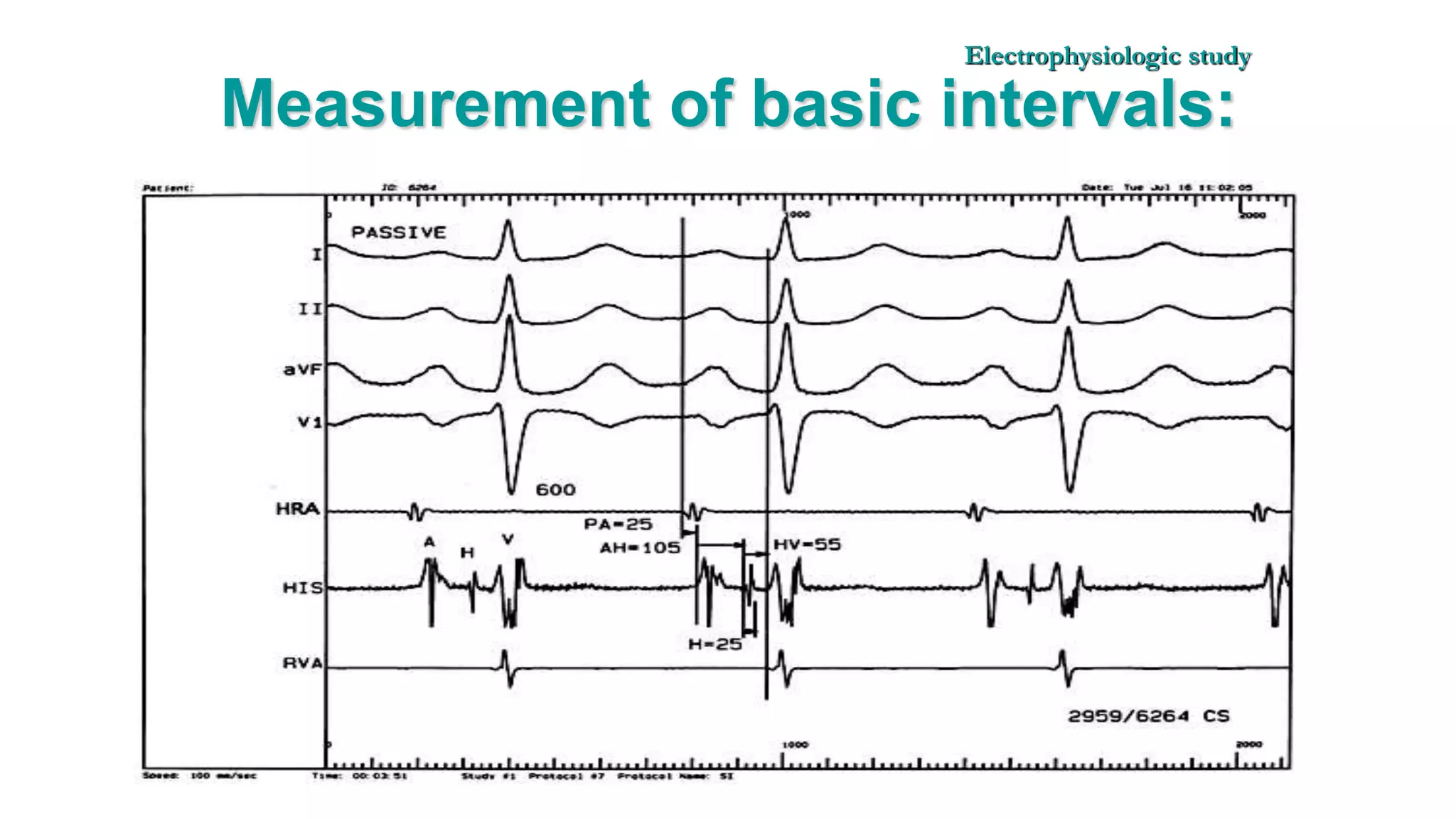 Basics of Electrophysiologic study, part 1 (2020)