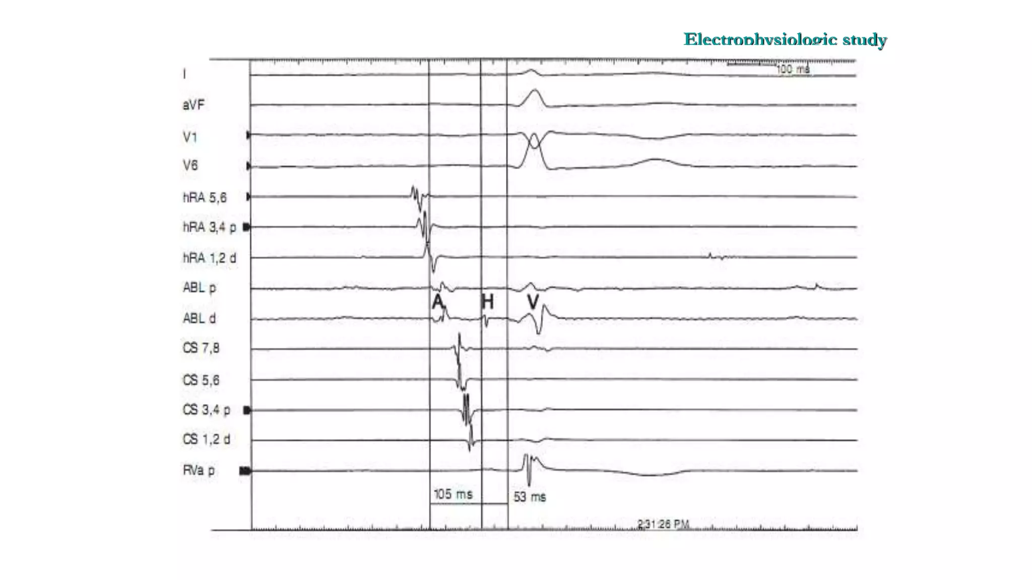 Basics of Electrophysiologic study, part 1 (2020)