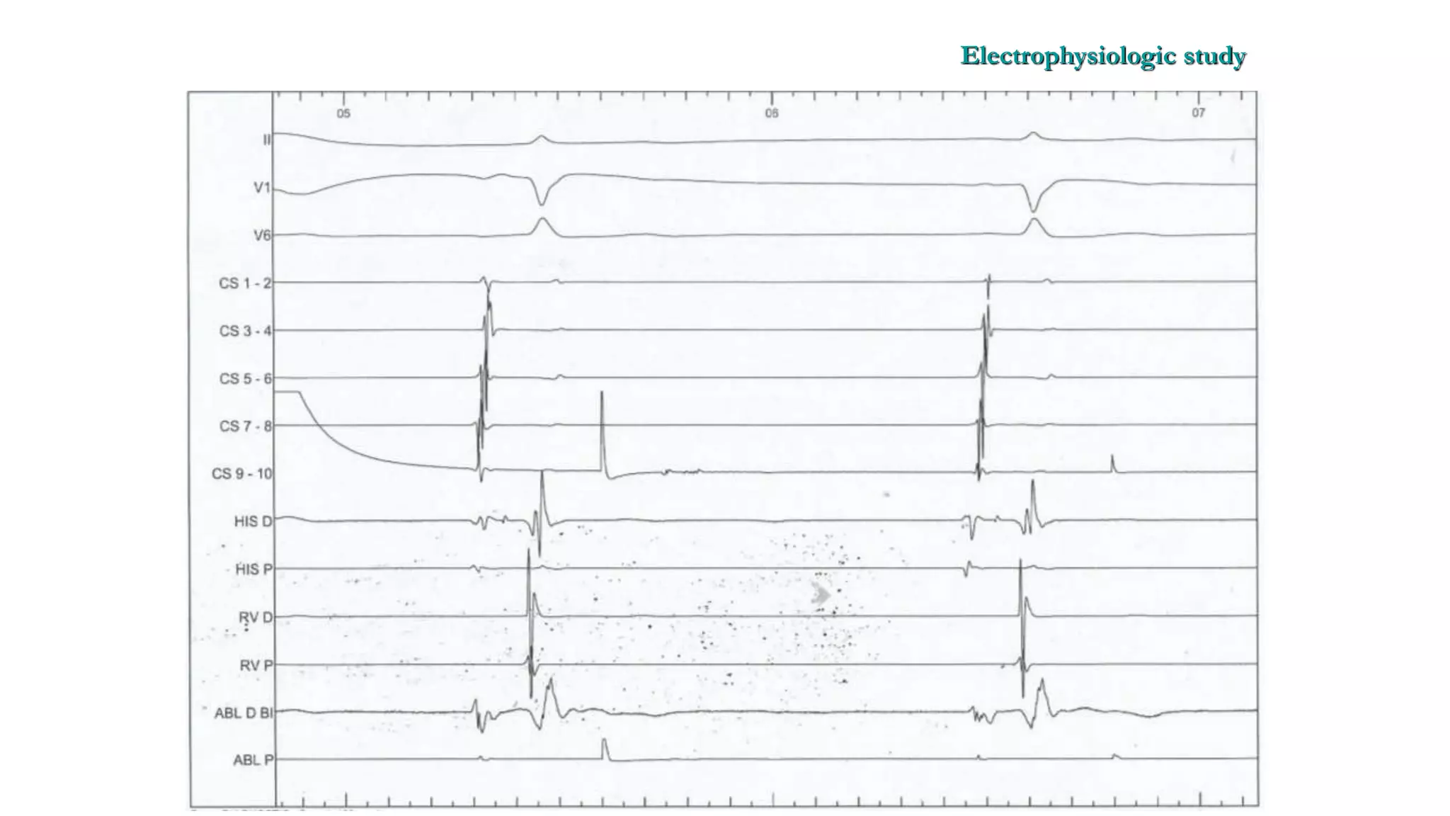 Basics of Electrophysiologic study, part 1 (2020)