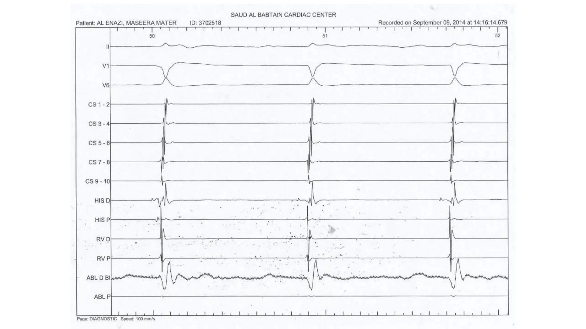Basics of Electrophysiologic study, part 1 (2020)