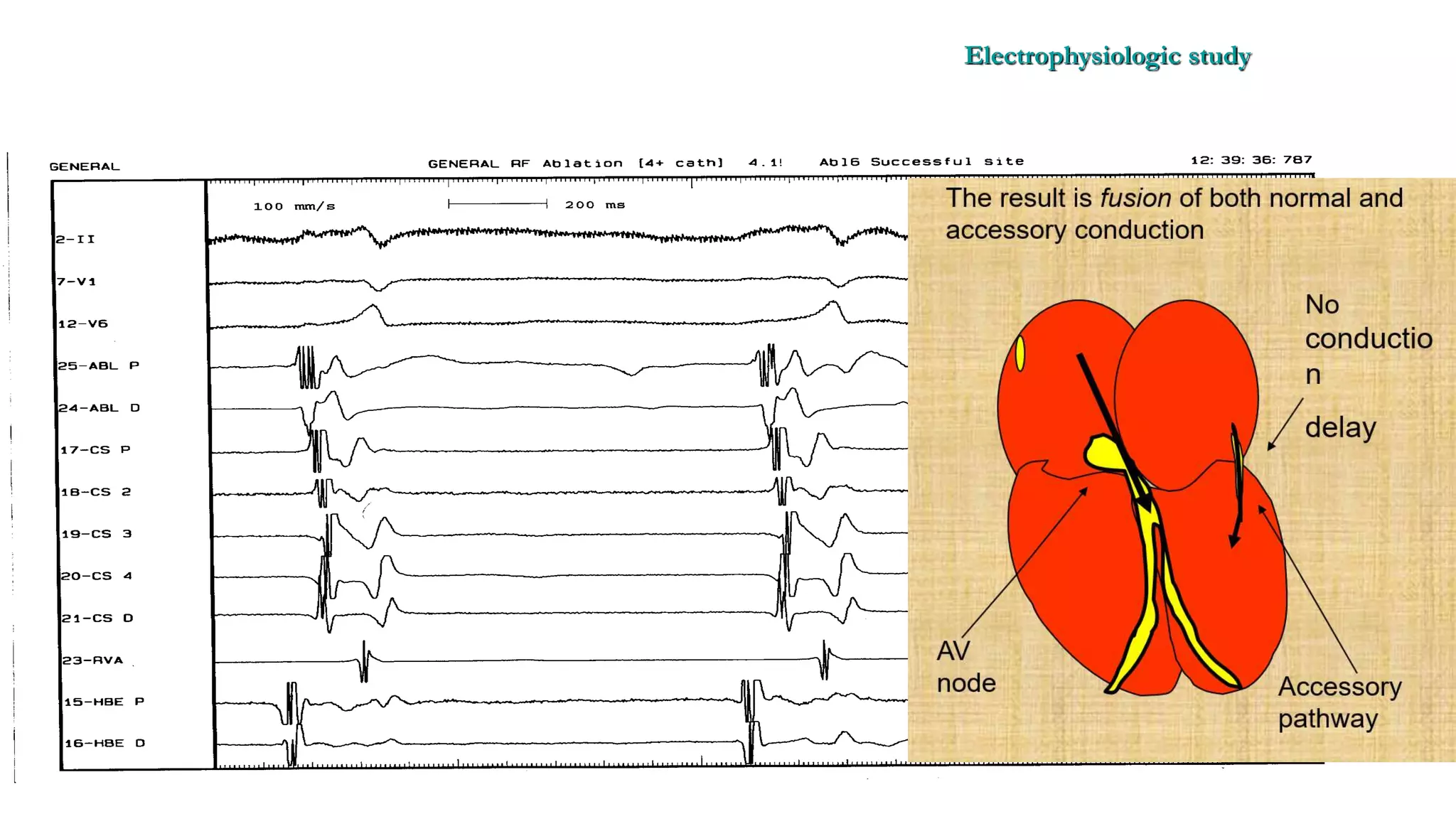 Basics of Electrophysiologic study, part 1 (2020)