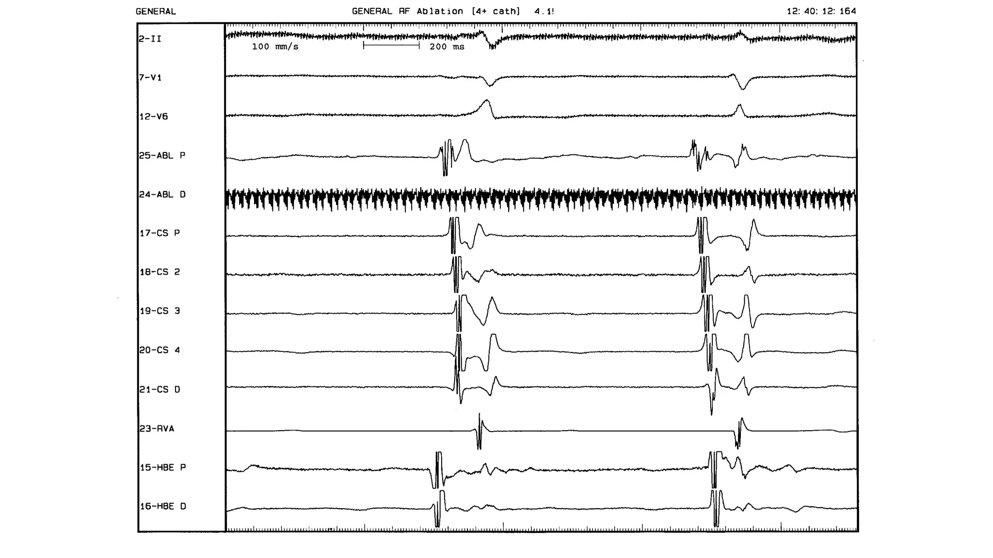 Basics of Electrophysiologic study, part 1 (2020)