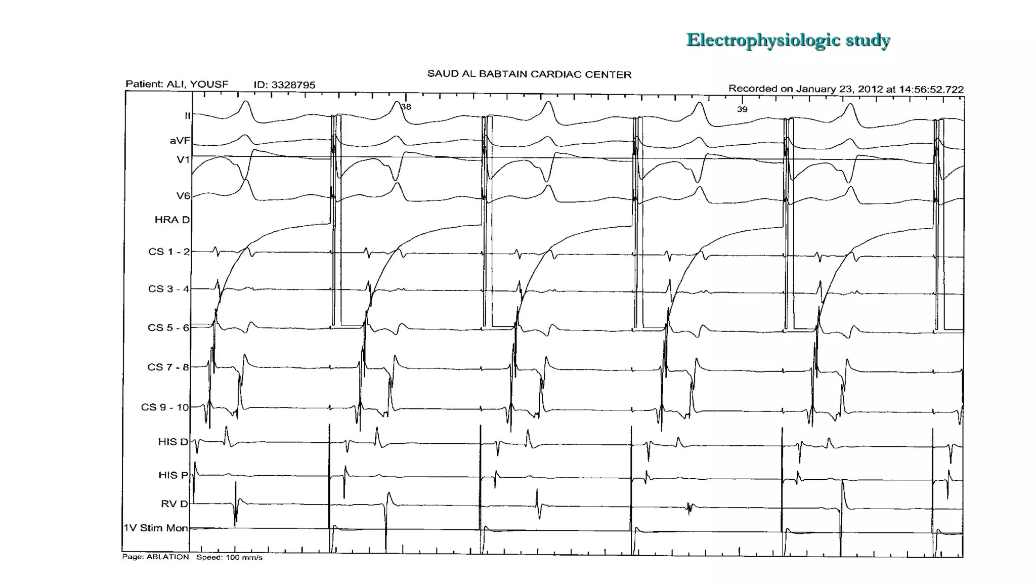 Basics of Electrophysiologic study, part 1 (2020)