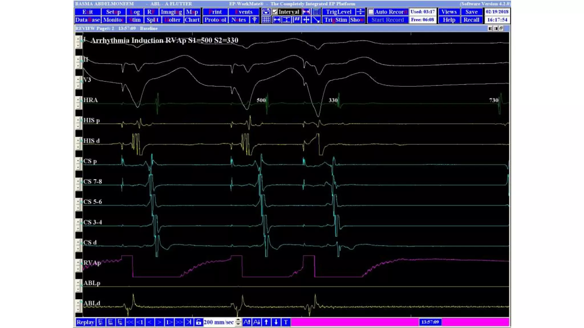 Basics of Electrophysiologic study, part 1 (2020)