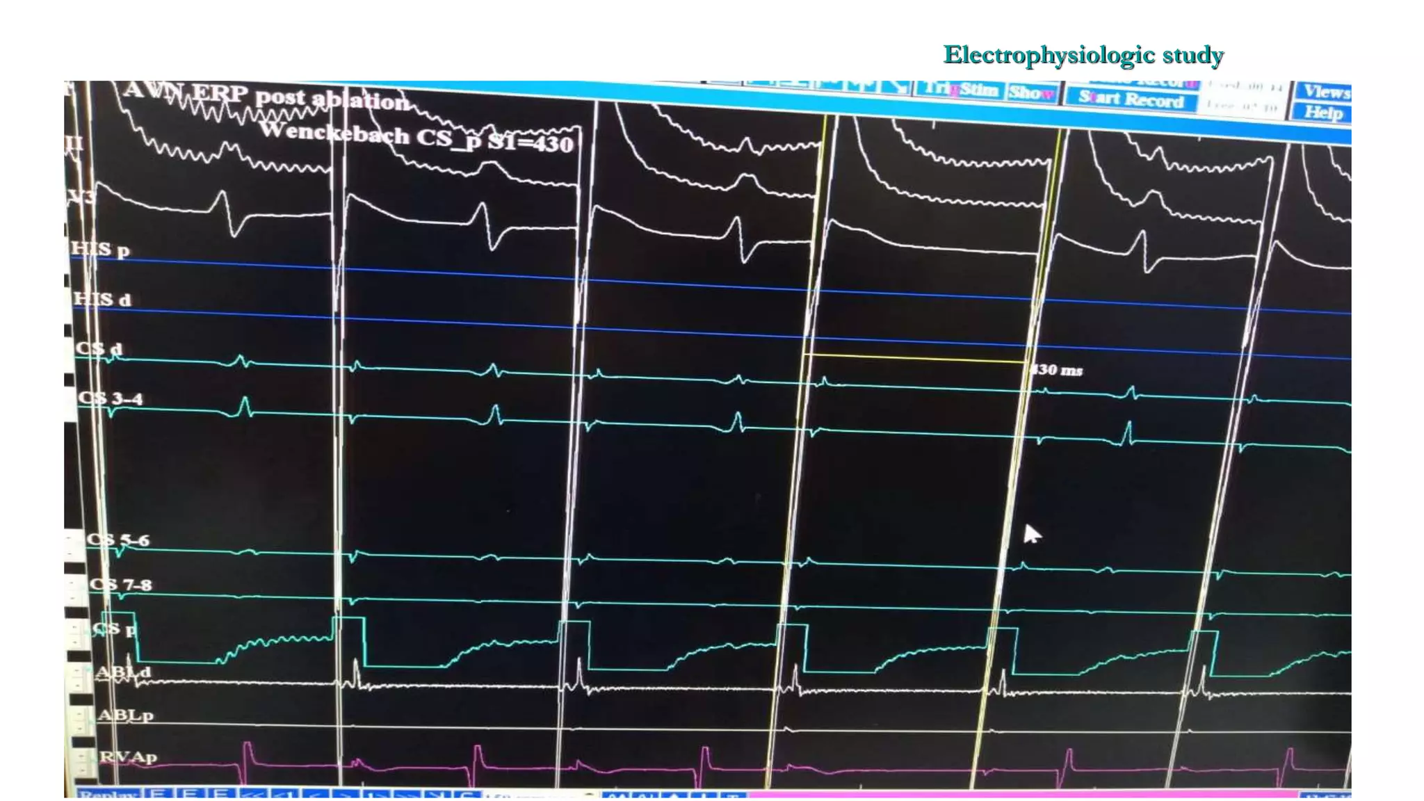 Basics of Electrophysiologic study, part 1 (2020)
