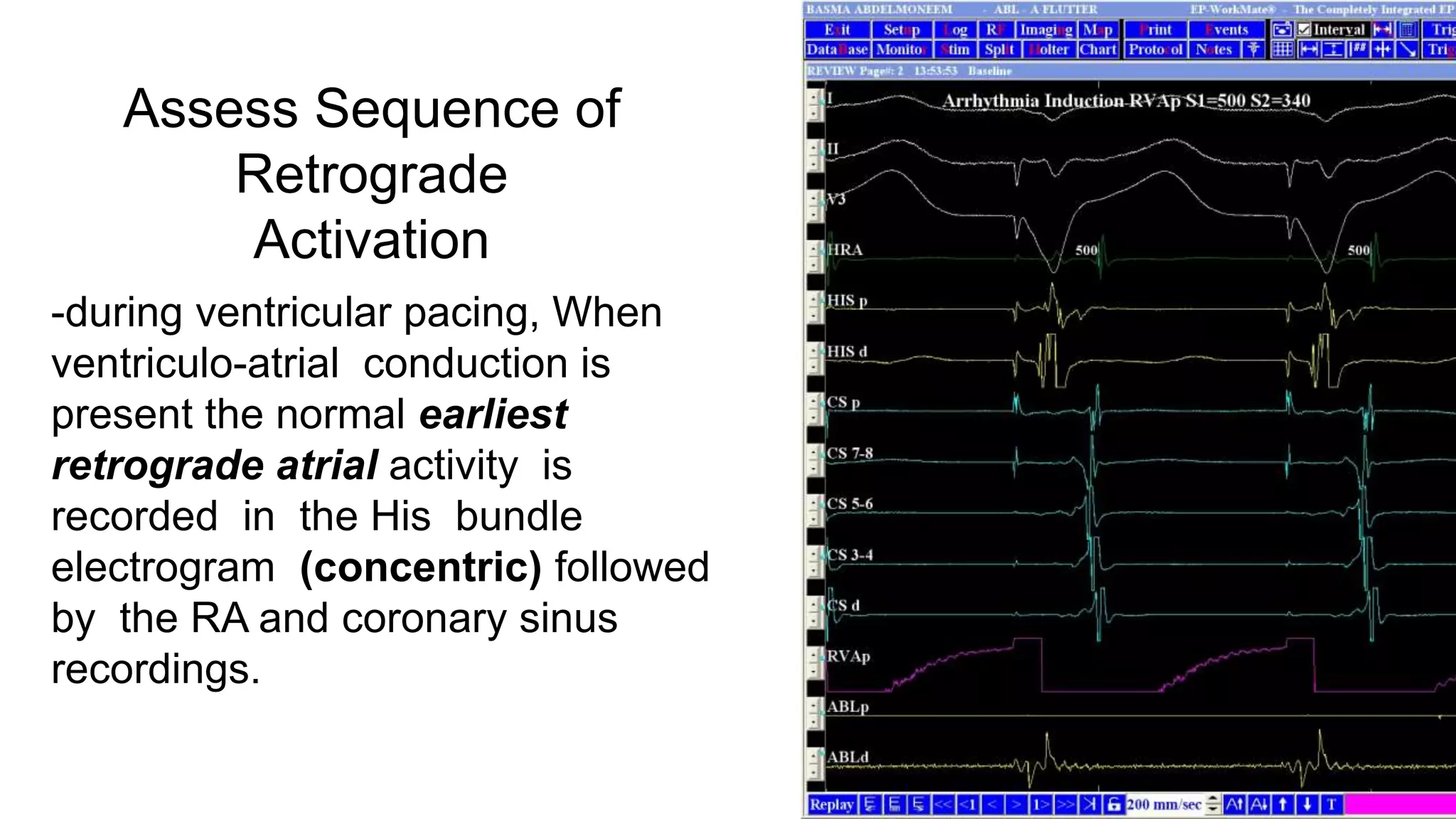 Basics of Electrophysiologic study, part 1 (2020)