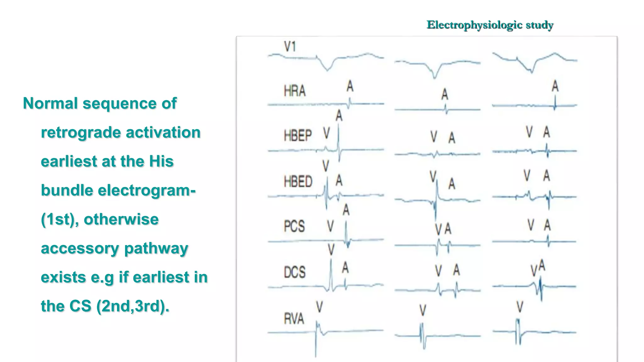 Basics of Electrophysiologic study, part 1 (2020)