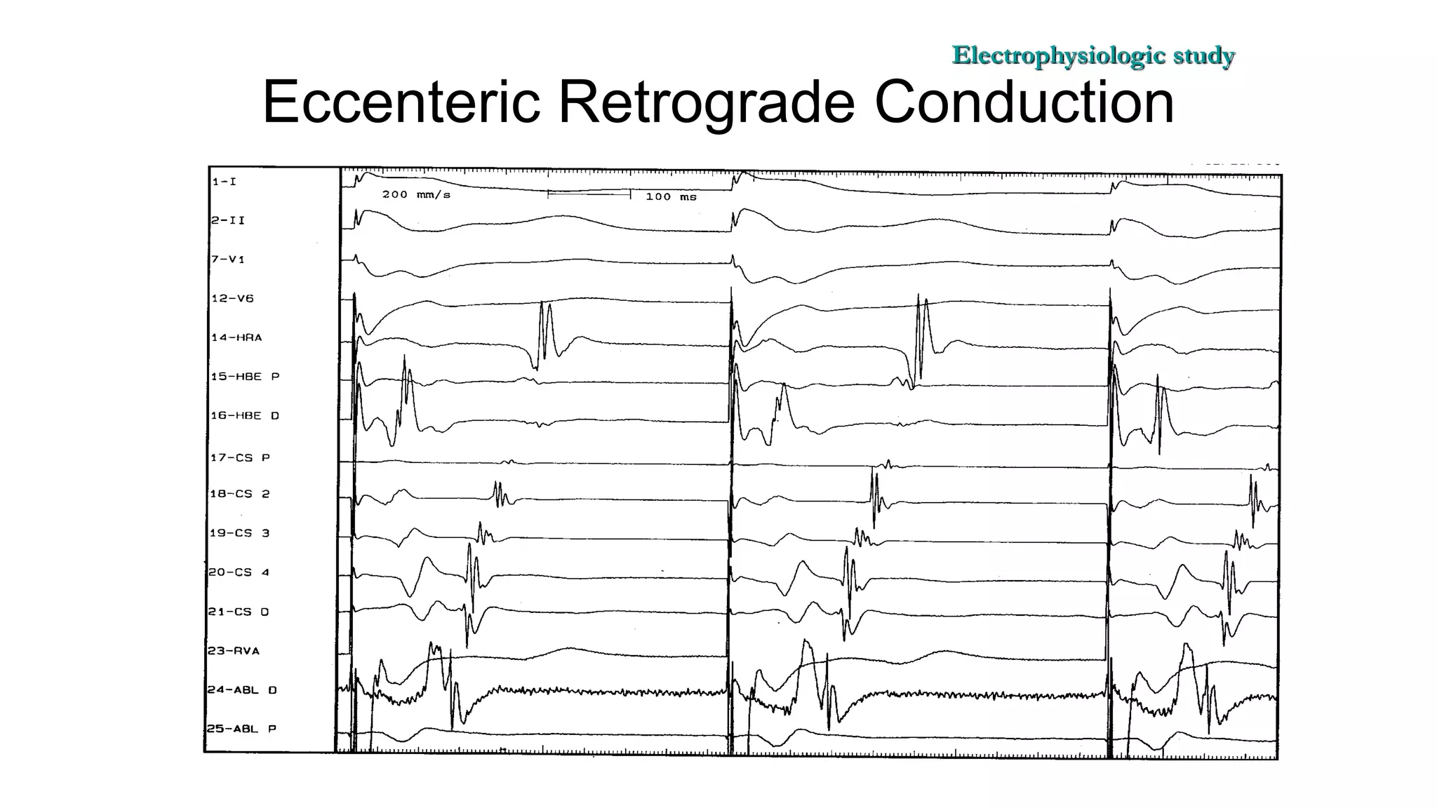 Basics of Electrophysiologic study, part 1 (2020)
