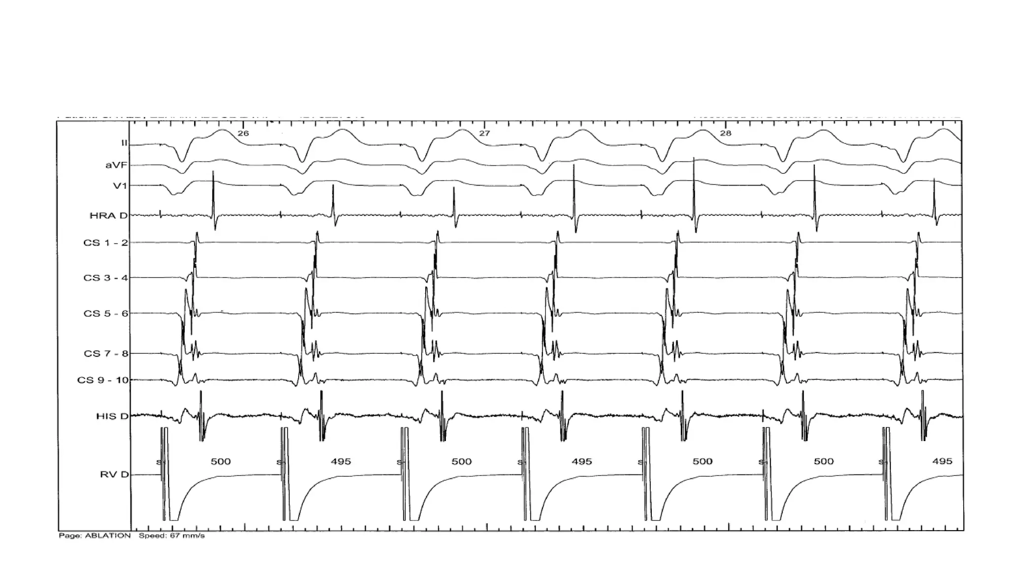 Basics of Electrophysiologic study, part 1 (2020)