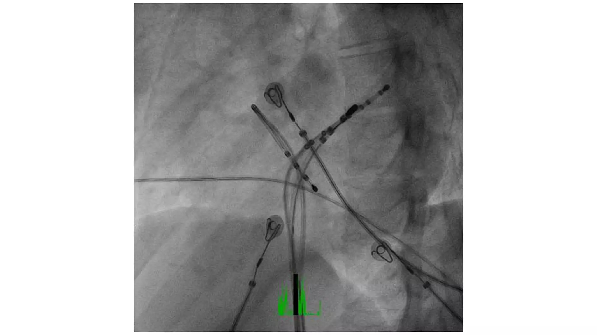 Basics of Electrophysiologic study, part 1 (2020)