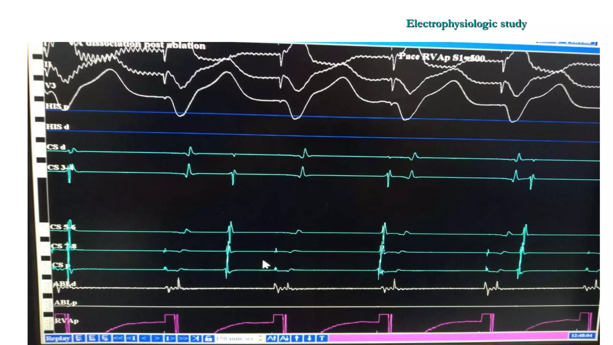 Basics of Electrophysiologic study, part 1 (2020)