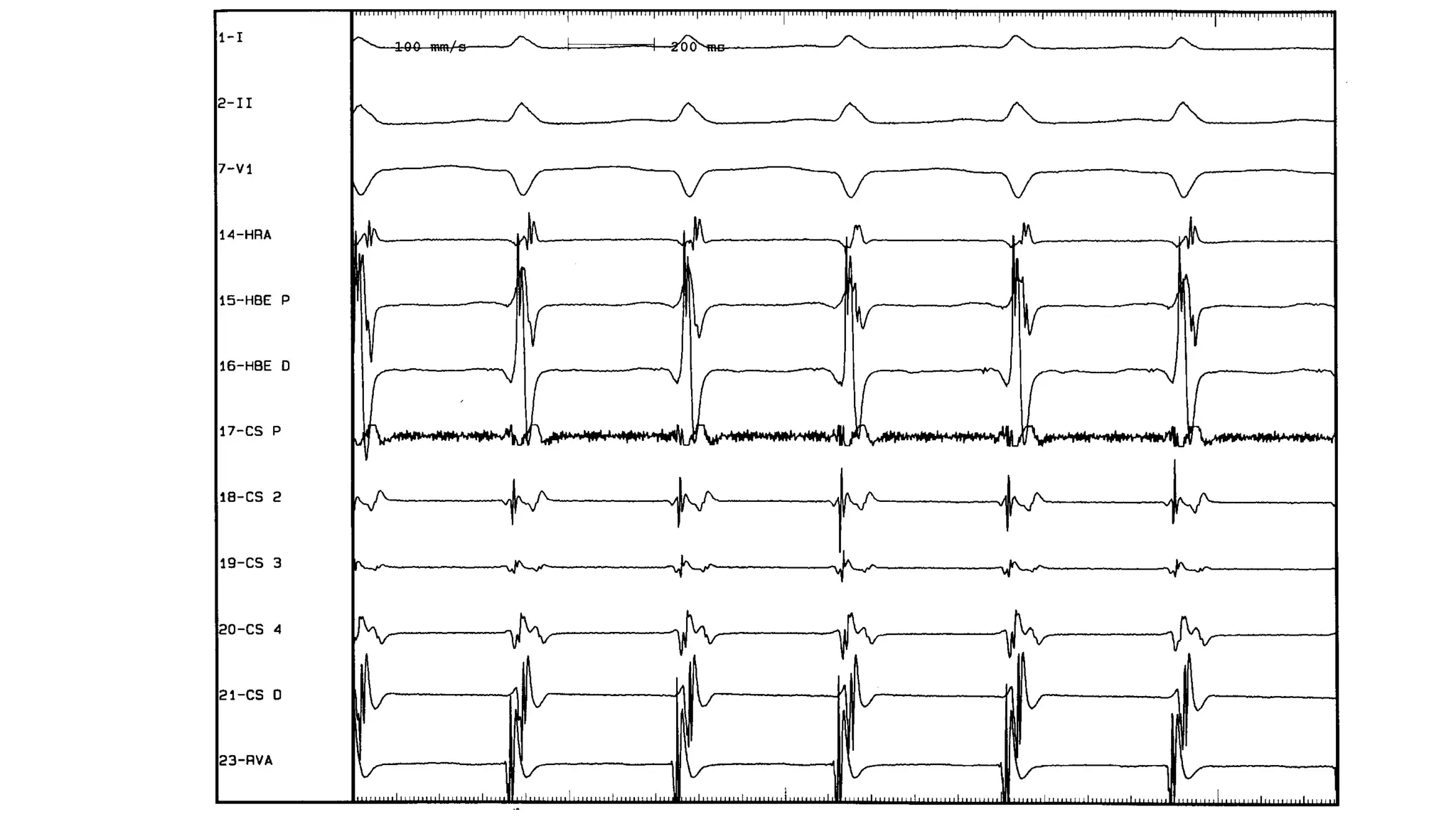 Basics of Electrophysiologic study, part 1 (2020)