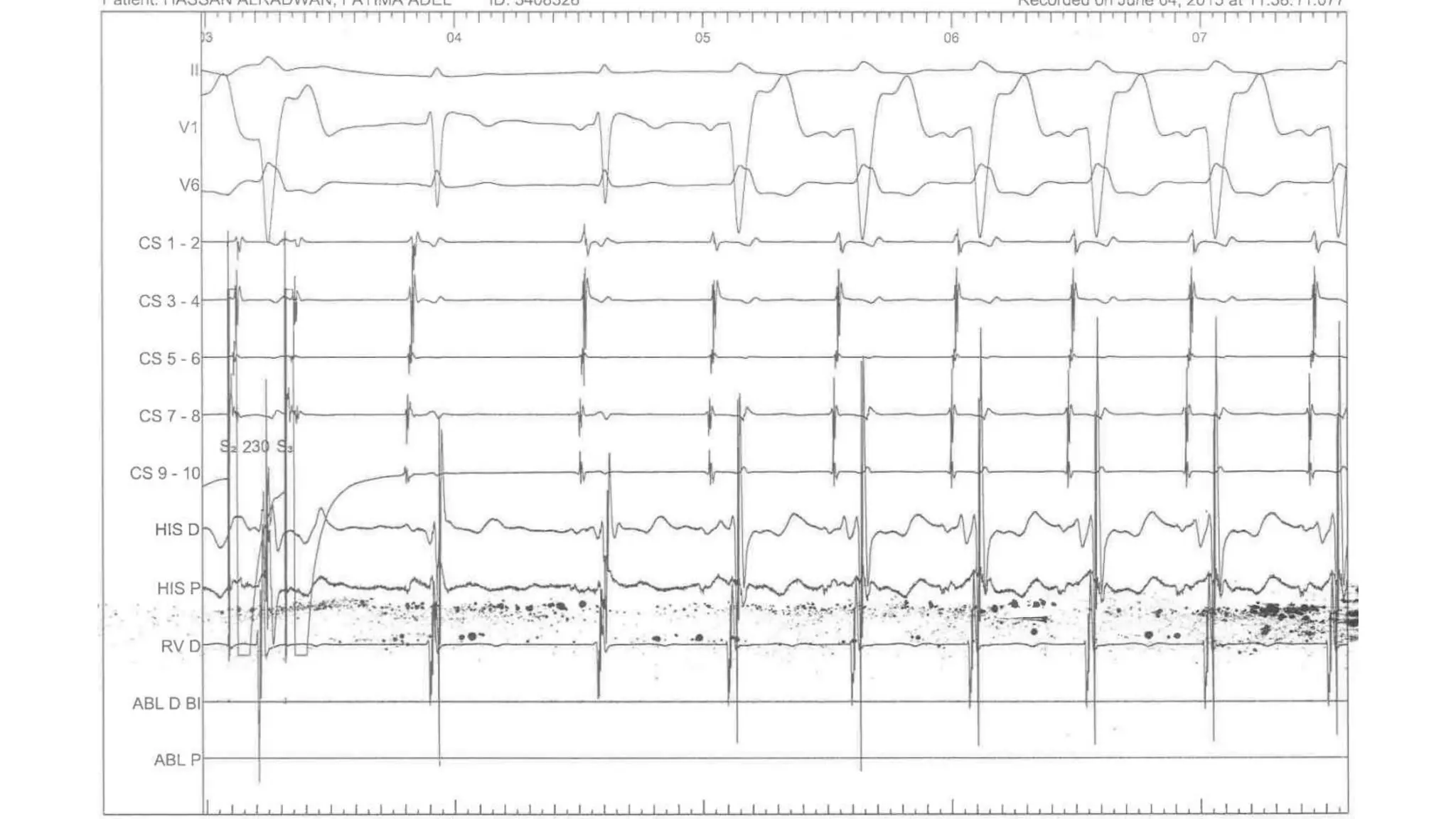 Basics of Electrophysiologic study, part 1 (2020)