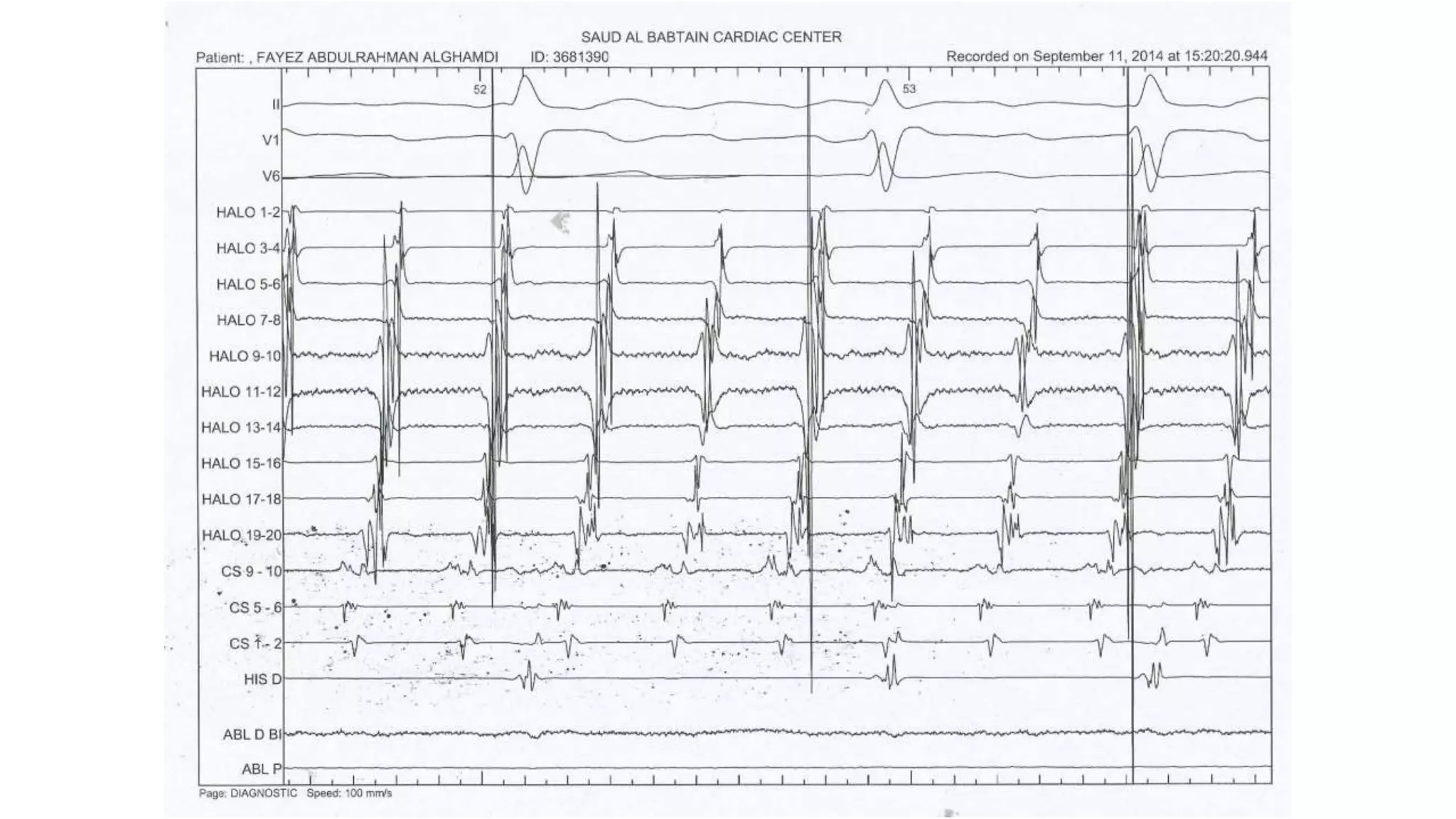 Basics of Electrophysiologic study, part 1 (2020)