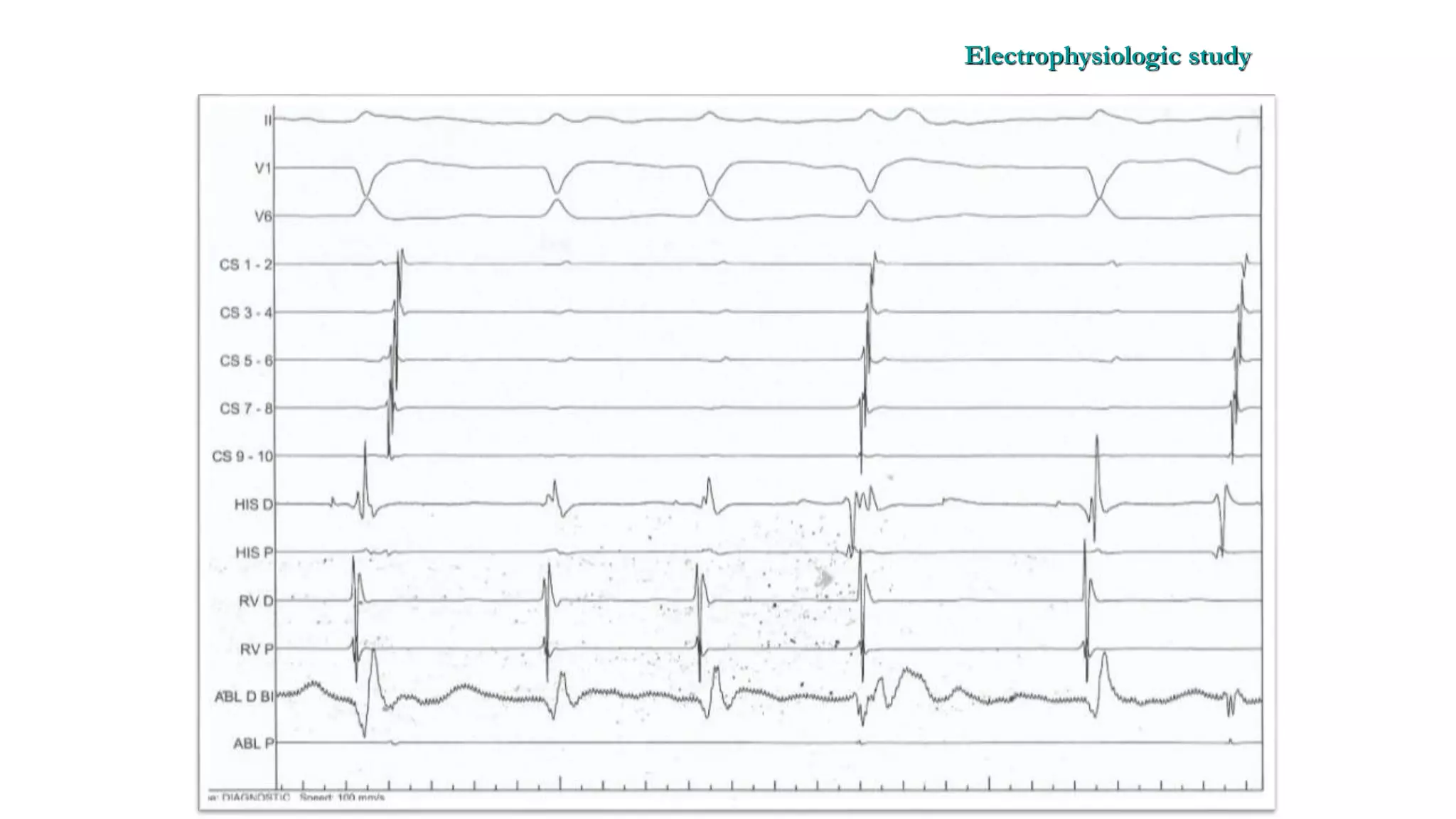 Basics of Electrophysiologic study, part 1 (2020)