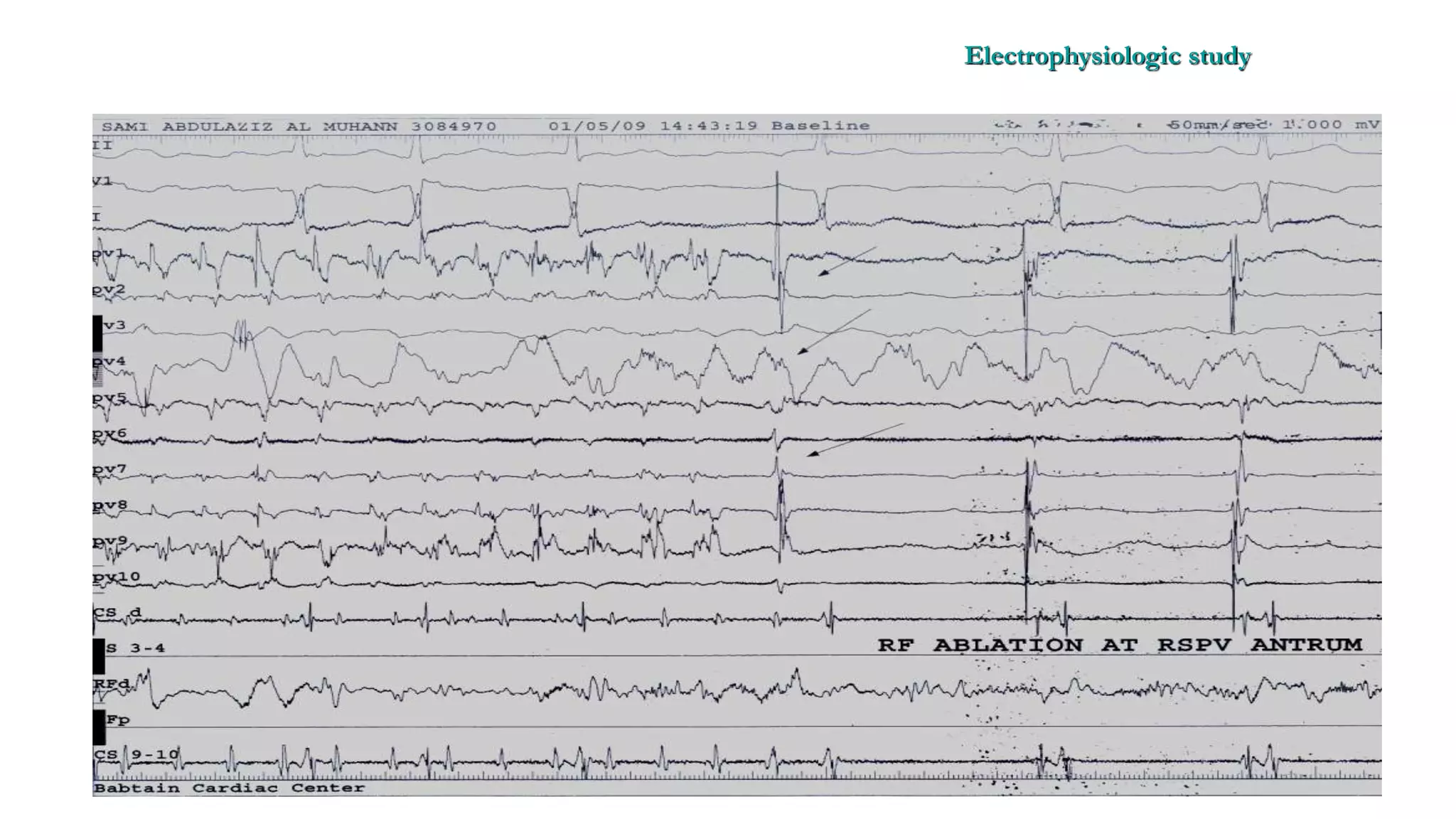 Basics of Electrophysiologic study, part 1 (2020)