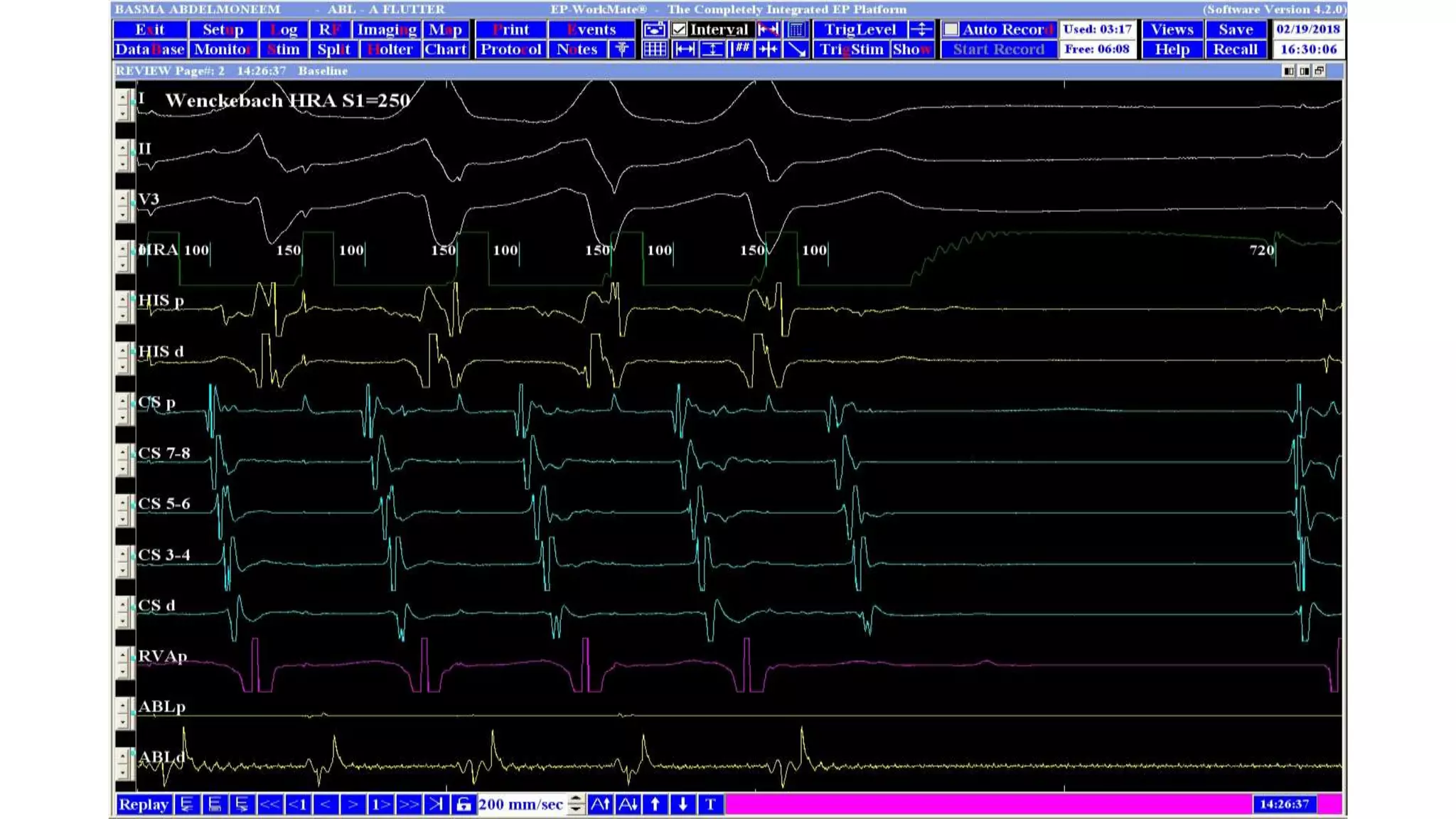 Basics of Electrophysiologic study, part 1 (2020)