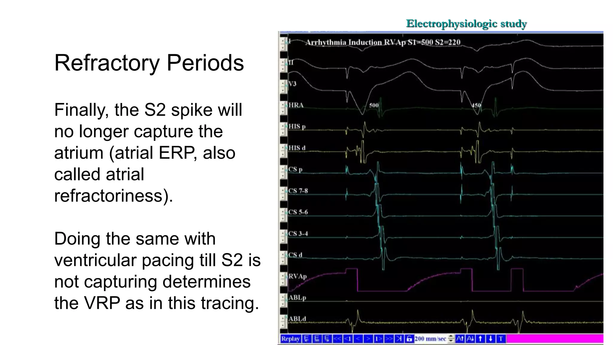 Basics of Electrophysiologic study, part 1 (2020)