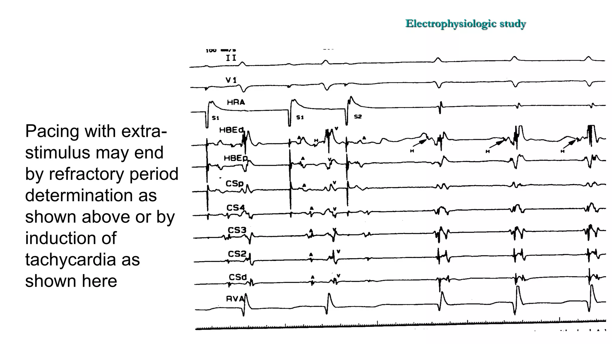 Basics of Electrophysiologic study, part 1 (2020)
