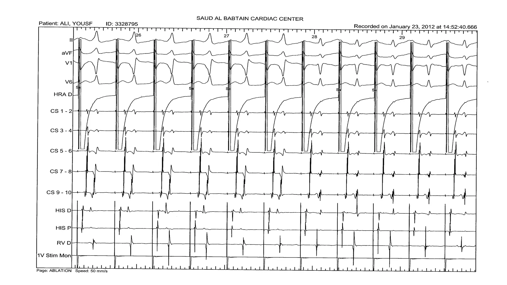Basics of Electrophysiologic study, part 1 (2020)