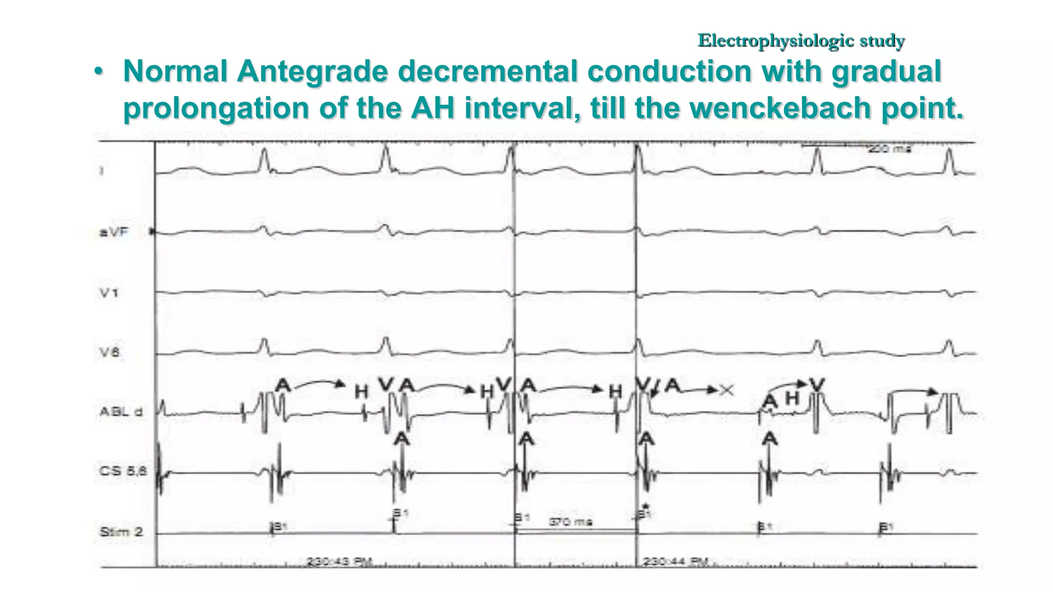 Basics of Electrophysiologic study, part 1 (2020)