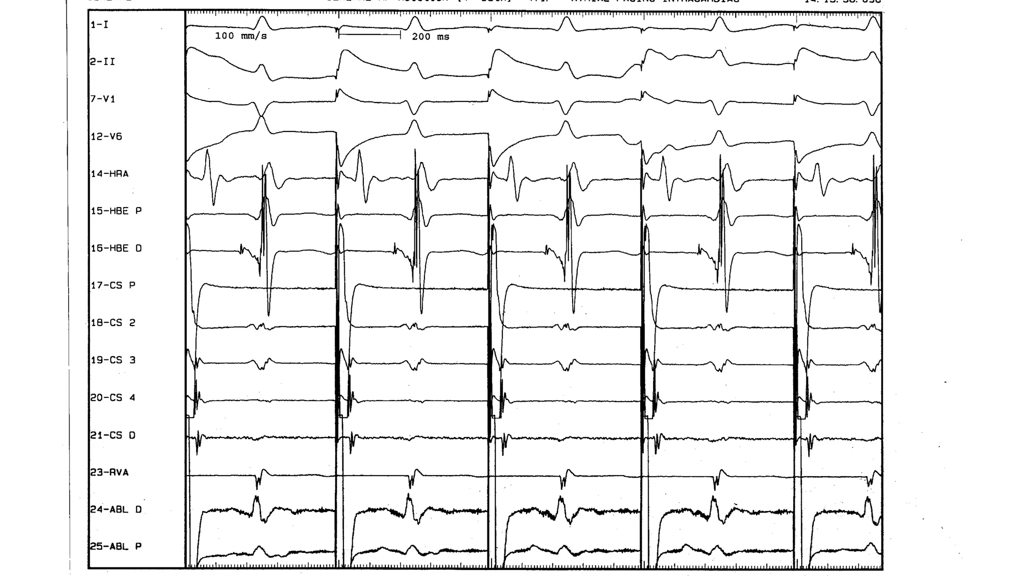 Basics of Electrophysiologic study, part 1 (2020)