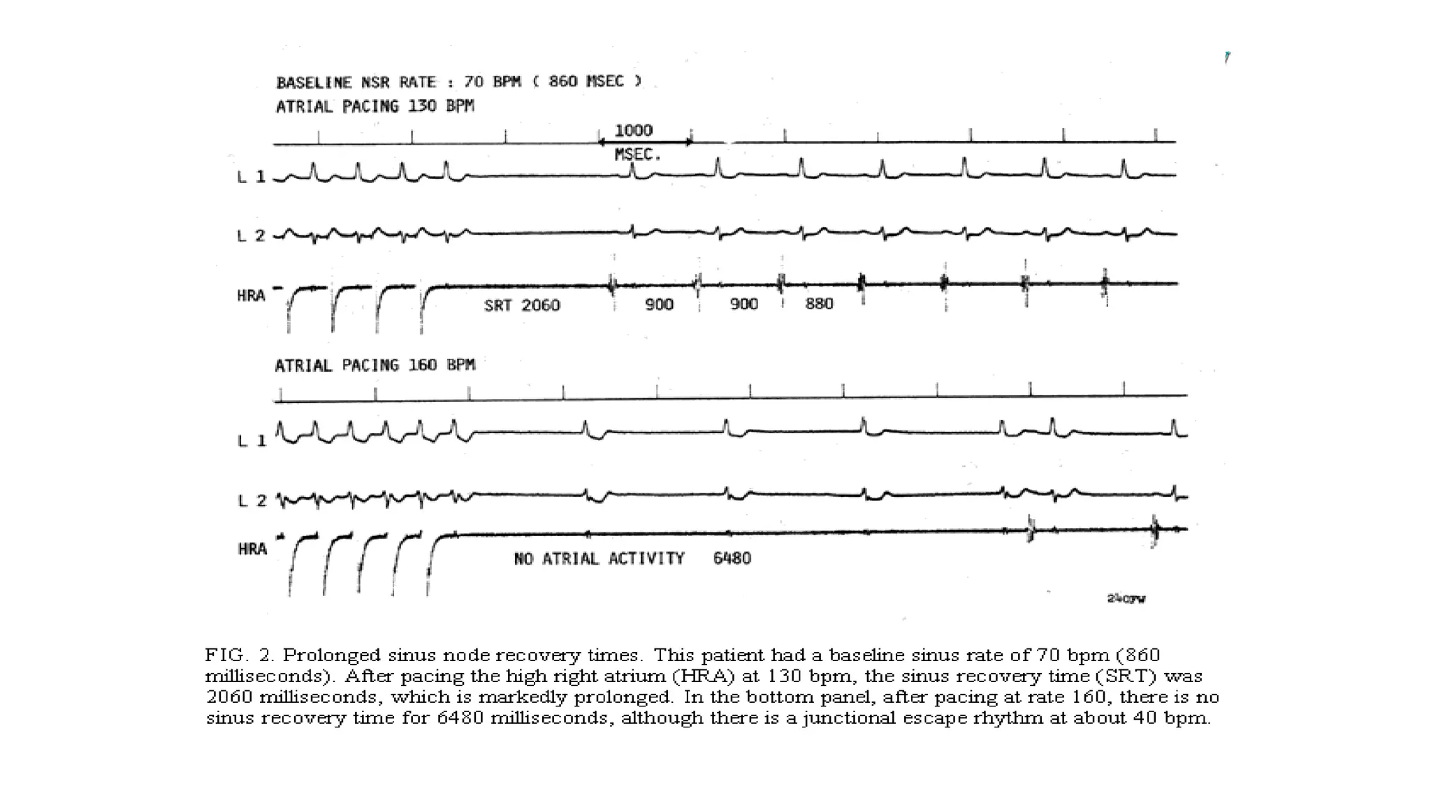 Basics of Electrophysiologic study, part 1 (2020)