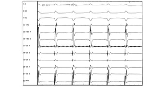 Basics of Electrophysiologic study, part 1 (2020) | PPTX