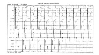 Basics of Electrophysiologic study, part 1 (2020) | PPTX
