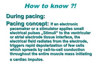 How to know ?!
During pacing:During pacing:
Pacing concept:Pacing concept: If an electronicIf an electronic
pacemaker or a stimulator applies smallpacemaker or a stimulator applies small
electrical pulses „Stimuli“ to the ventricularelectrical pulses „Stimuli“ to the ventricular
or atrial electrode tissue interface, theor atrial electrode tissue interface, the
electrical field radiates from the electrode,electrical field radiates from the electrode,
triggers rapid depolarization of few cellstriggers rapid depolarization of few cells
which spreads by cell-to-cell conductionwhich spreads by cell-to-cell conduction
throughout the entire muscle mass initiatingthroughout the entire muscle mass initiating
a cardiac impulse.a cardiac impulse.
 
