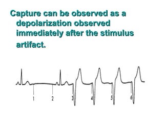 Capture can be observed as aCapture can be observed as a
depolarization observeddepolarization observed
immediately after the stimulusimmediately after the stimulus
artifact.artifact.
 
