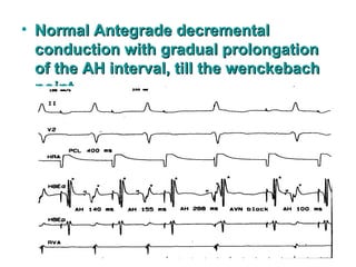 • Normal Antegrade decrementalNormal Antegrade decremental
conduction with gradual prolongationconduction with gradual prolongation
of the AH interval, till the wenckebachof the AH interval, till the wenckebach
point.point.
 