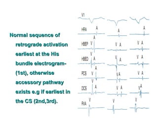 Normal sequence ofNormal sequence of
retrograde activationretrograde activation
earliest at the Hisearliest at the His
bundle electrogram-bundle electrogram-
(1st), otherwise(1st), otherwise
accessory pathwayaccessory pathway
exists e.g if earliest inexists e.g if earliest in
the CS (2nd,3rd).the CS (2nd,3rd).
 