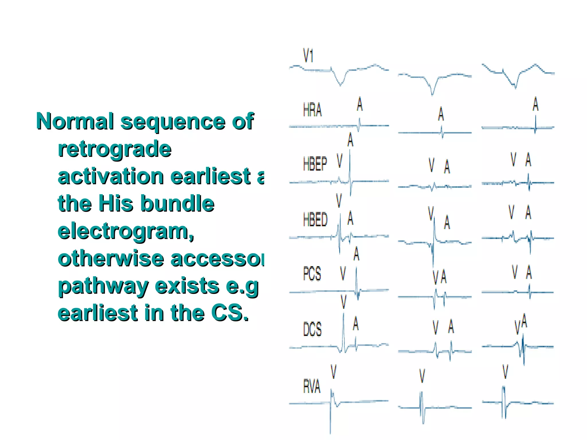 Normal Electrical Pathways Electrophysiologic basis part3 | PPT