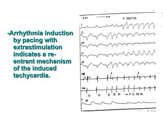 -Arrhythmia induction-Arrhythmia induction
bby pacing withy pacing with
extrastimulationextrastimulation
indicates a re-indicates a re-
entrant mechanismentrant mechanism
of the inducedof the induced
tachycardia.tachycardia.
 