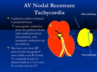 AV Nodal Reentrant
Tachycardia
 2 pathways within or limited
to perinodal tissue
 anterograde conduction
down fast pathway blocks
with conduction down
slow pathway, with
retrograde conduction up
fast pathway.
 May have very short RP
interval with retrograde P
wave visible as an R’ in lead
V1 or psuedo-S wave in
inferior leads in 1/3 of cases .
No p wave seen in 2/3
Slow pathway
Fast pathway
 