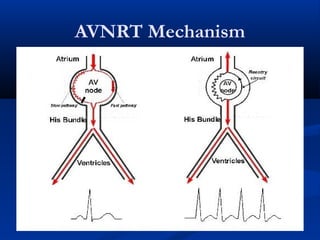 AVNRT Mechanism
 