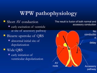 WPW pathophysiology
 Short AV conduction
 early excitation of ventricle
at site of accessory pathway
 Bizarre upstroke of QRS
 abnormal initial site of
depolarization
 Wide QRS
 early initiation of
ventricular depolarization
The result is fusion of both normal and
accessory conduction
No
conductio
n
delay
AV
node Accessory
pathway
 