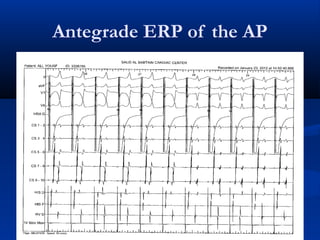 Antegrade ERP of the AP
 